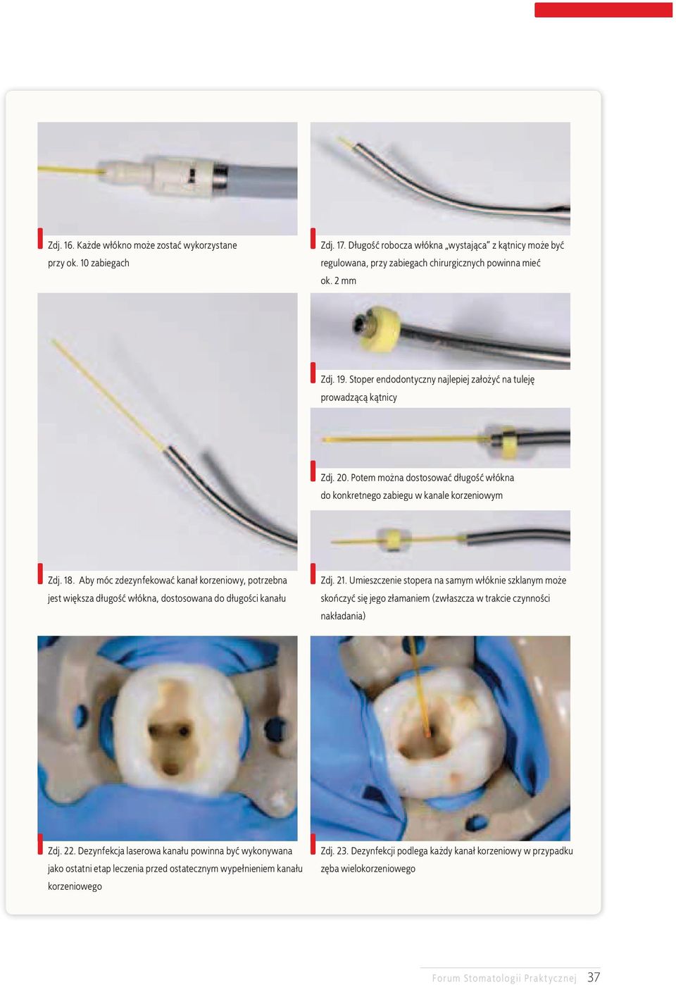 Aby móc zdezynfekować kanał korzeniowy, potrzebna jest większa długość włókna, dostosowana do długości kanału Zdj. 21.