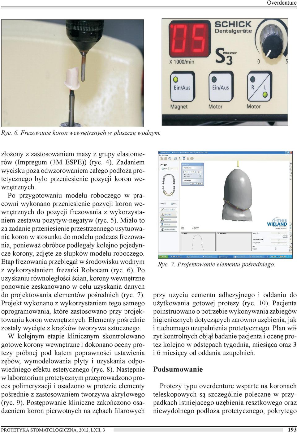 Po przygotowaniu modelu roboczego w pracowni wykonano przeniesienie pozycji koron wewnętrznych do pozycji frezowania z wykorzystaniem zestawu pozytyw-negatyw (ryc. 5).