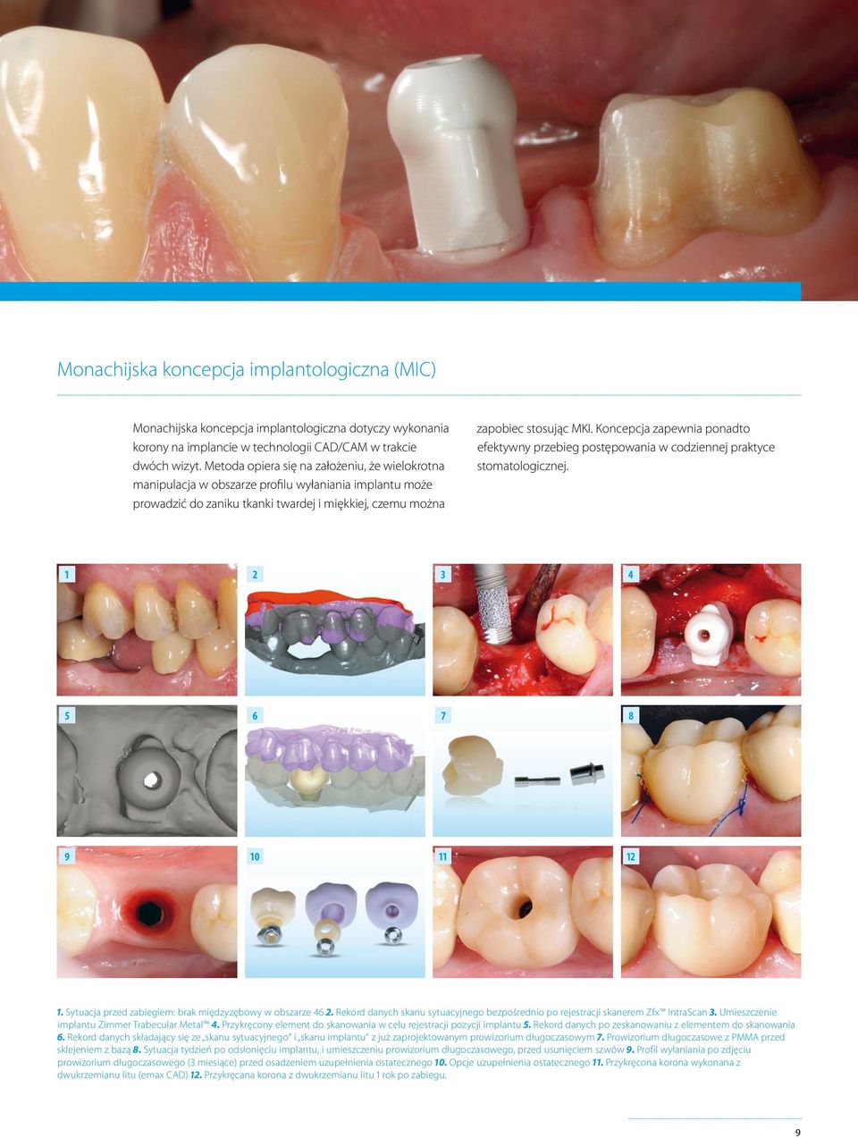 Koncepcja zapewnia ponadto efektywny przebieg postępowania w codziennej praktyce stomatologicznej. 1 2 3 4 5 6 7 8 9 10 11 12 1. Sytuacja przed zabiegiem: brak międzyzębowy w obszarze 46 2.