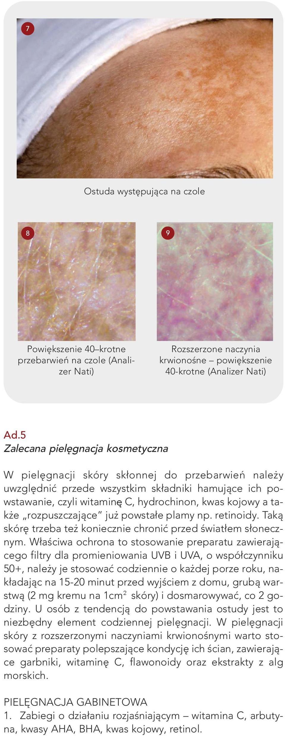 także rozpuszczające już powstałe plamy np. retinoidy. Taką skórę trzeba też koniecznie chronić przed światłem słonecznym.