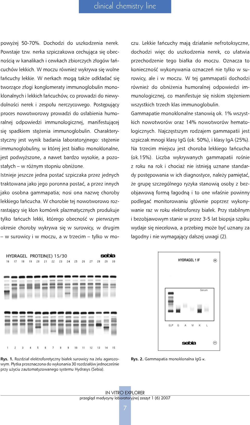 W nerkach mogą także odkładać się tworzące złogi konglomeraty immunoglobulin monoklonalnych i lekkich łańcuchów, co prowadzi do niewydolności nerek i zespołu nerczycowego.