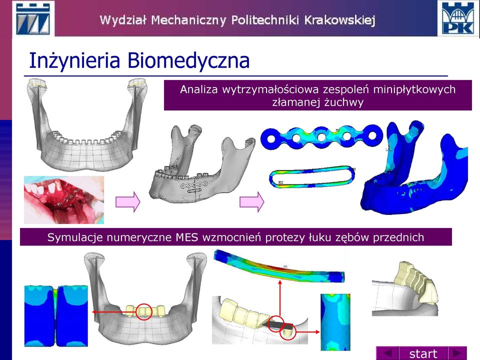 minipłytkowych złamanej żuchwy