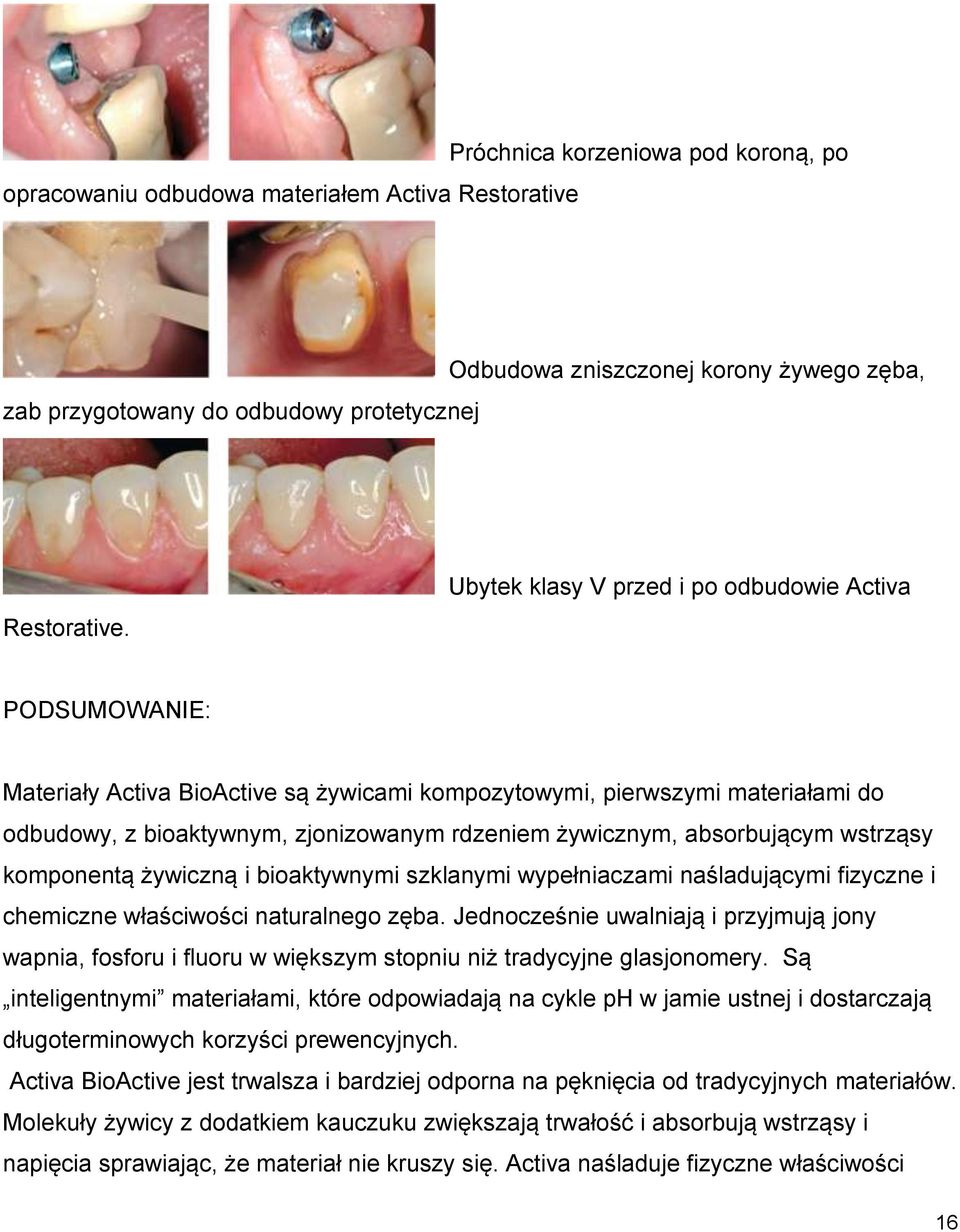 absorbującym wstrząsy komponentą żywiczną i bioaktywnymi szklanymi wypełniaczami naśladującymi fizyczne i chemiczne właściwości naturalnego zęba.