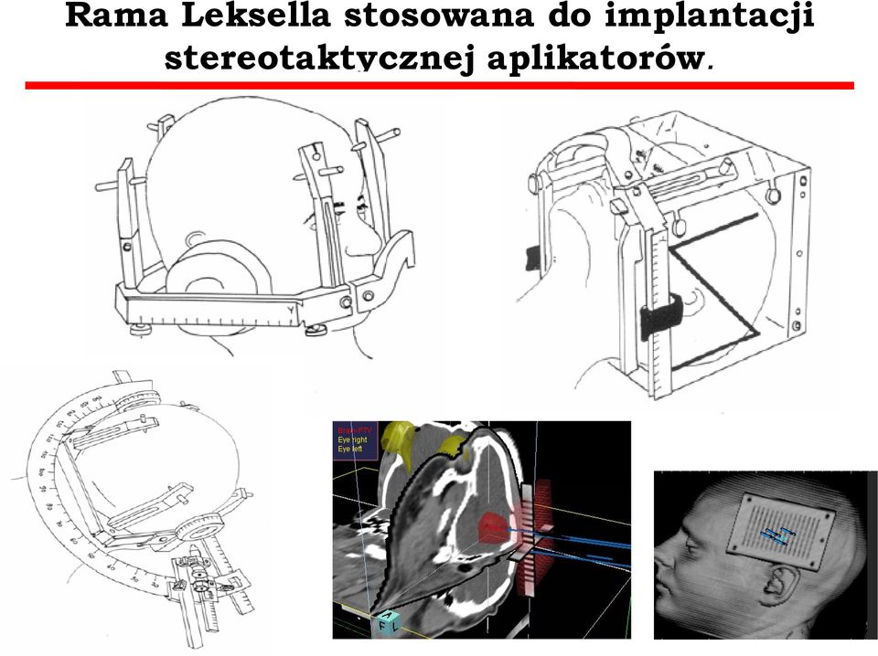 implantacji