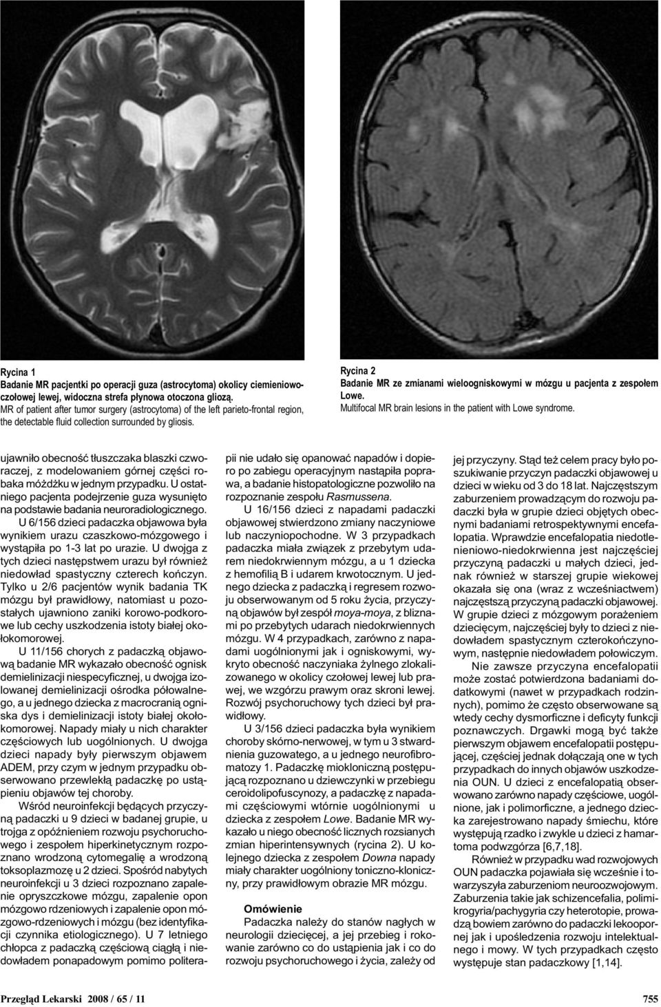 Rycina Badanie MR ze zmianami wieloogniskowymi w mózgu u pacjenta z zespo³em Lowe. Multifocal MR brain lesions in the patient with Lowe syndrome.