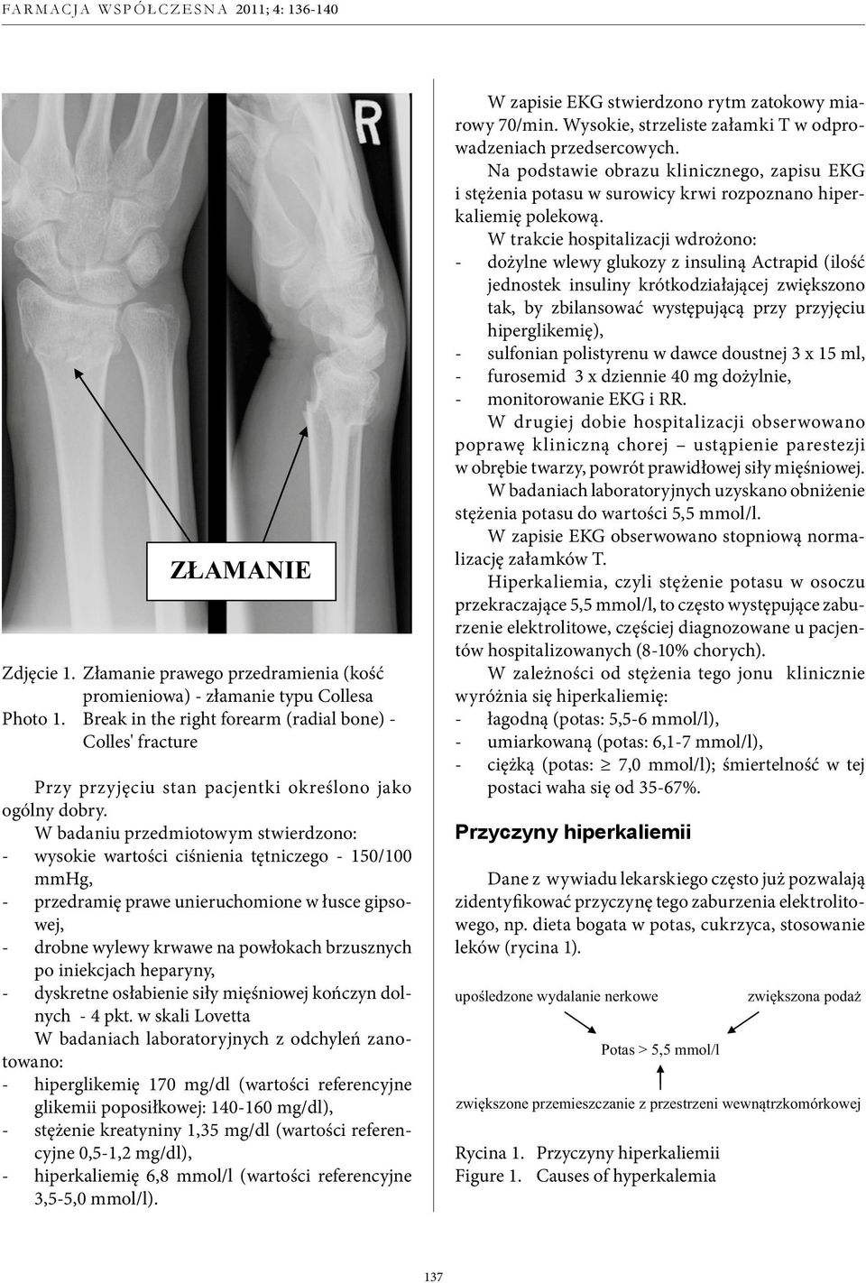 W badaniu przedmiotowym stwierdzono: - wysokie wartości ciśnienia tętniczego - 150/100 mmhg, - przedramię prawe unieruchomione w łusce gipsowej, - drobne wylewy krwawe na powłokach brzusznych po