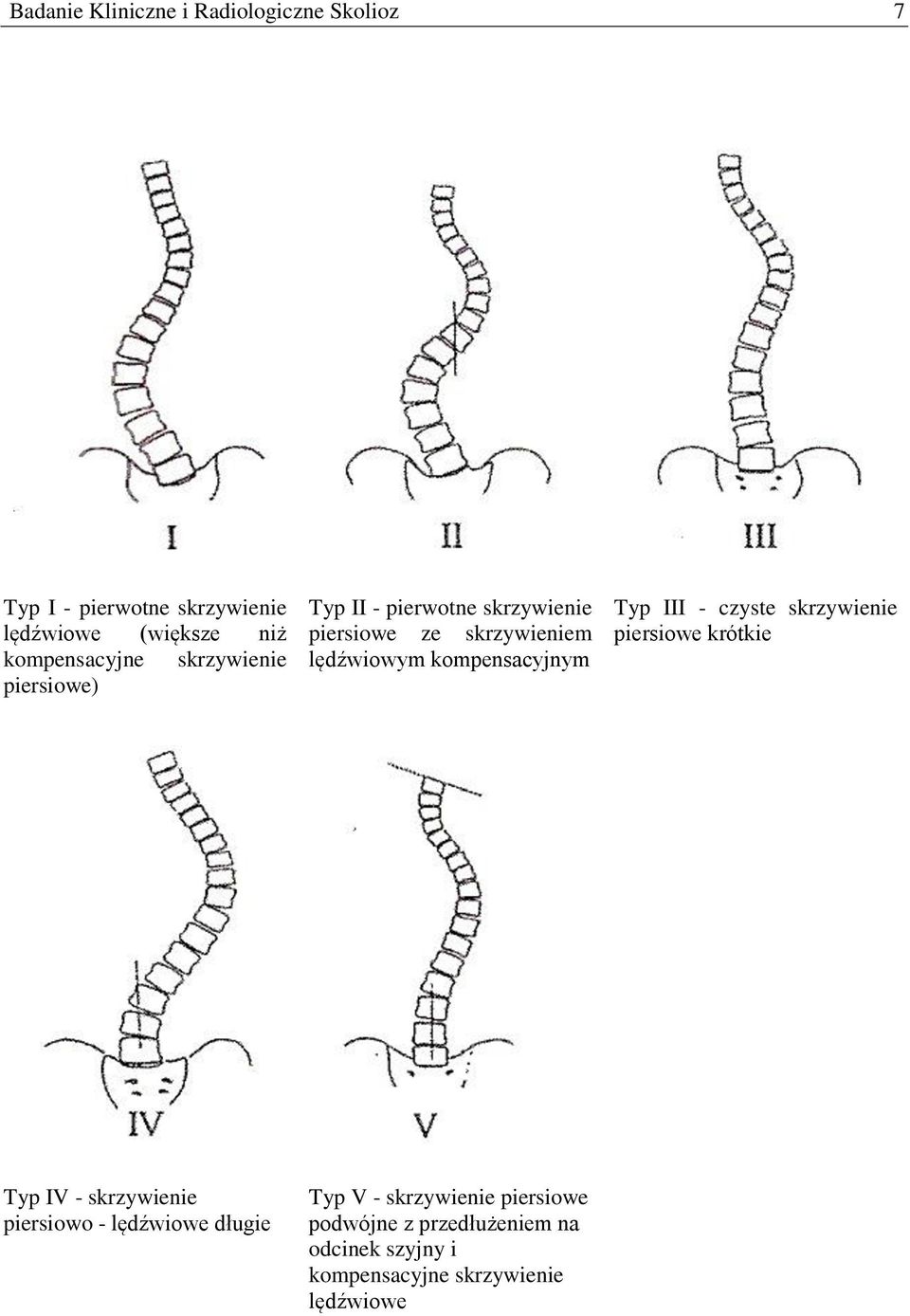 kompensacyjnym Typ III - czyste skrzywienie piersiowe krótkie Typ IV - skrzywienie piersiowo - lędźwiowe
