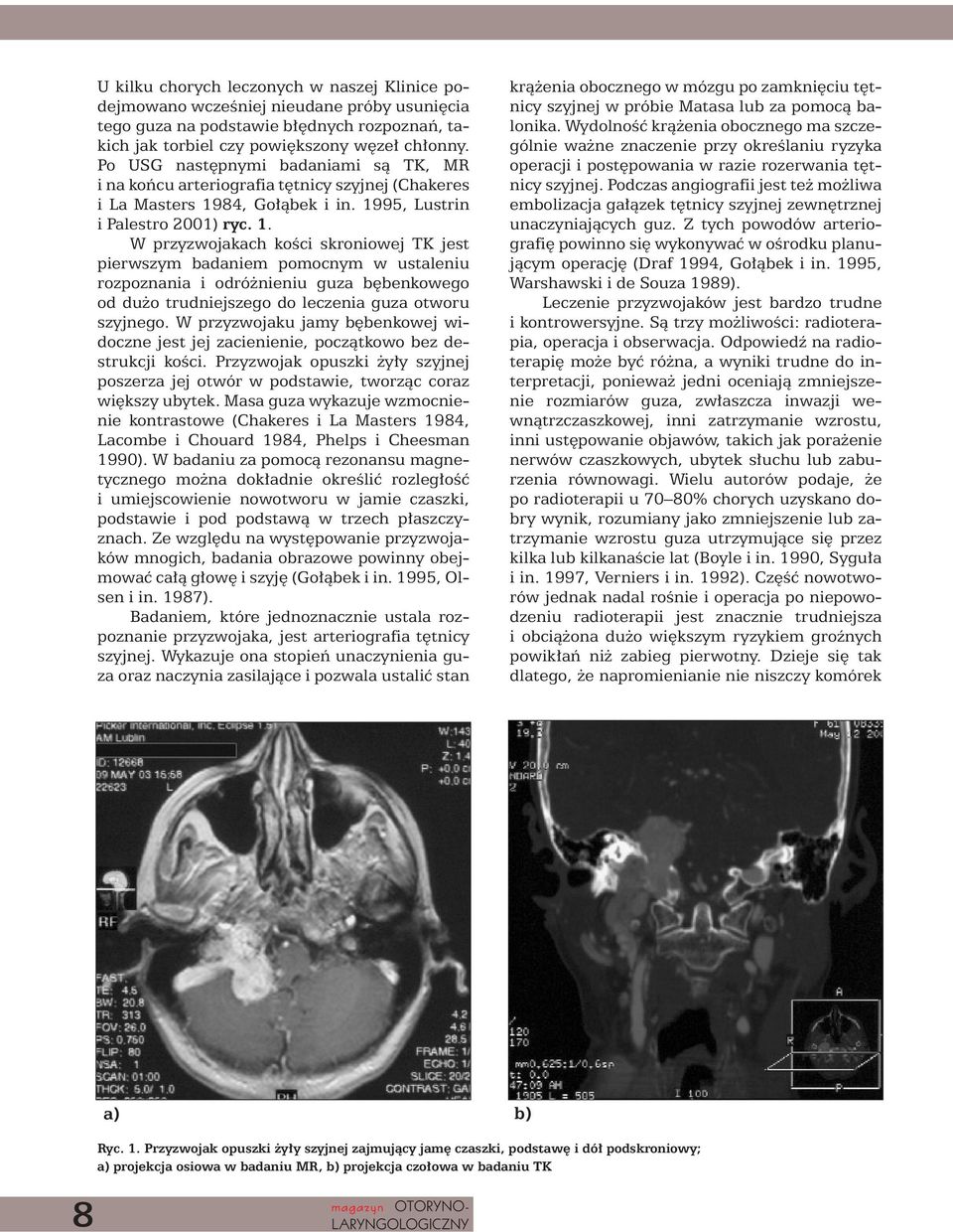 84, Go àbek i in. 1995, Lustrin ipalestro 2001) ryc. 1. W przyzwojakach koêci skroniowej TK jest pierwszym badaniem pomocnym w ustaleniu rozpoznania i odró nieniu guza b benkowego od du o trudniejszego do leczenia guza otworu szyjnego.