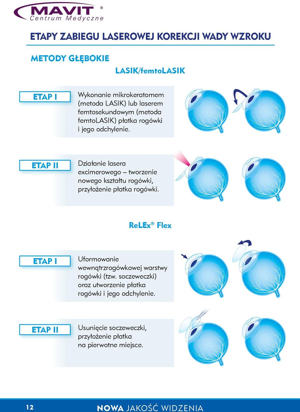 ETAP II Działanie lasera excimerowego tworzenie nowego kształtu rogówki, przyłożenie płatka rogówki.