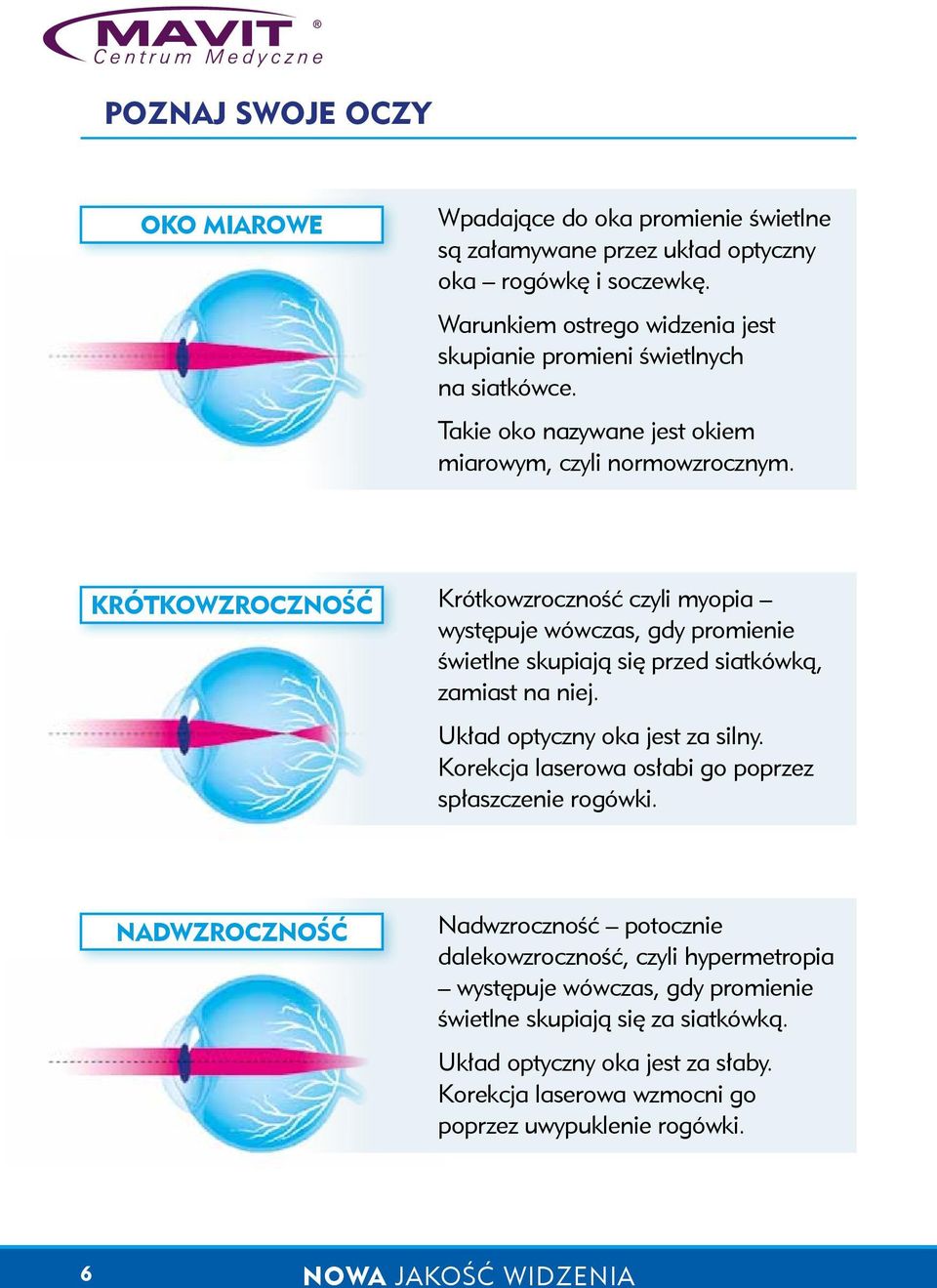 KRÓTKOWZROCZNOŚĆ Krótkowzroczność czyli myopia występuje wówczas, gdy promienie świetlne skupiają się przed siatkówką, zamiast na niej. Układ optyczny oka jest za silny.