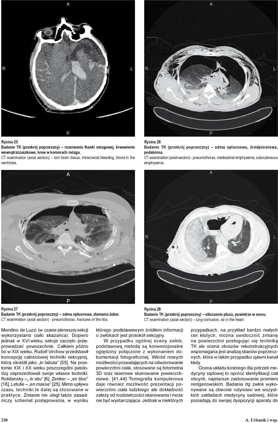 CT examination (axial section) - pneumothorax, mediastinal emphysema, subcutaneous emphysema. Rycina 27 Badanie TK (przekrój poprzeczny) odma opłucnowa, złamania żeber.