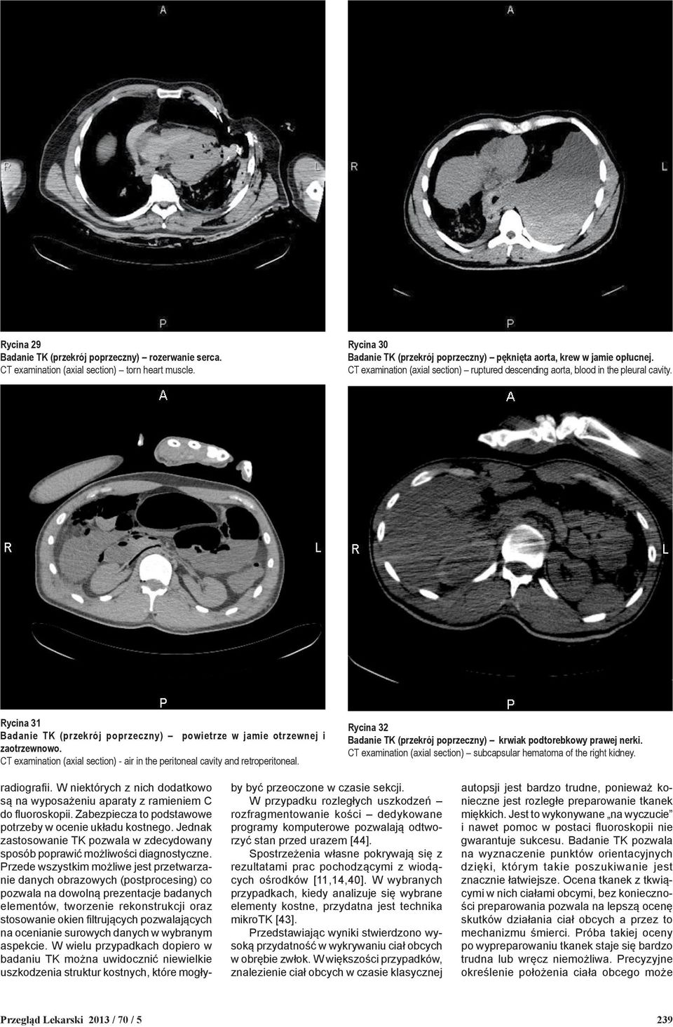 CT examination (axial section) - air in the peritoneal cavity and retroperitoneal. Rycina 32 Badanie TK (przekrój poprzeczny) krwiak podtorebkowy prawej nerki.