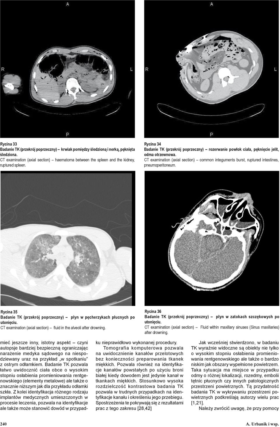 Rycina 35 Badanie TK (przekrój poprzeczny) płyn w pęcherzykach płucnych po utonięciu. CT examination (axial section) fluid in the alveoli after drowning.