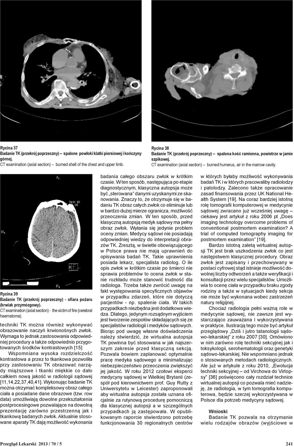 Rycina 39 Badanie TK (przekrój poprzeczny) - ofiara pożaru (krwiak przymózgowy). CT examination (axial section) - the victim of fire (cerebral haematoma).