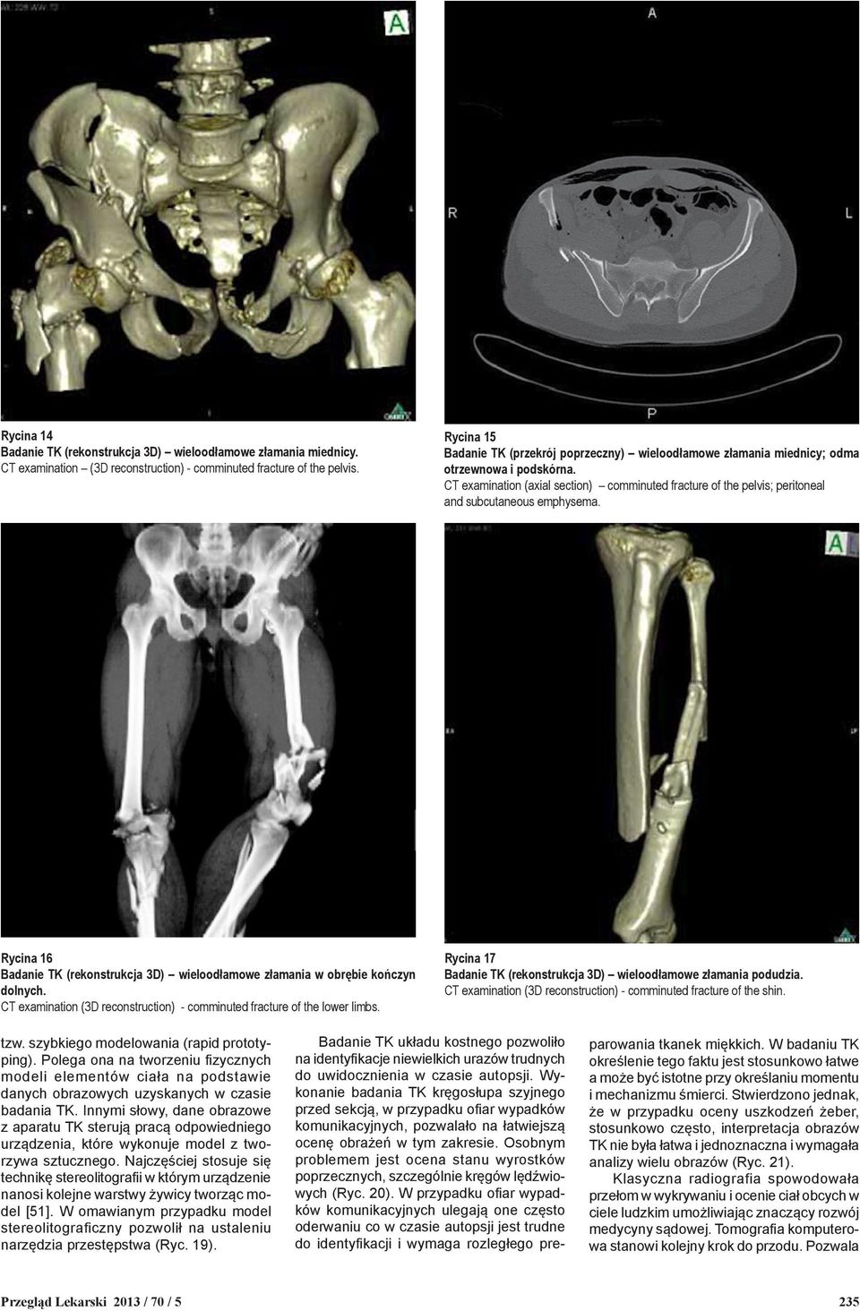 CT examination (axial section) comminuted fracture of the pelvis; peritoneal and subcutaneous emphysema. Rycina 16 Badanie TK (rekonstrukcja 3D) wieloodłamowe złamania w obrębie kończyn dolnych.