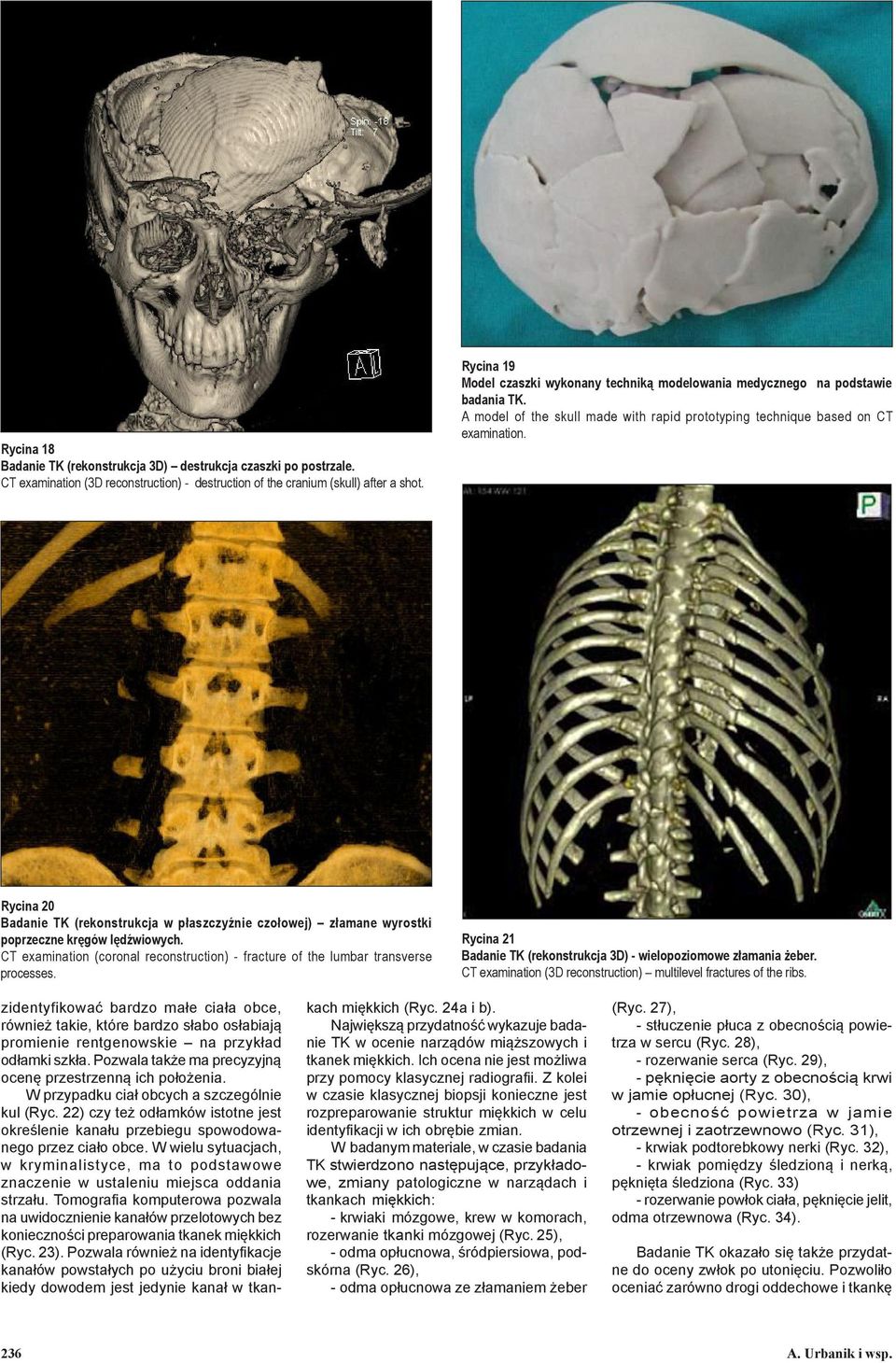 Rycina 20 Badanie TK (rekonstrukcja w płaszczyźnie czołowej) złamane wyrostki poprzeczne kręgów lędźwiowych. CT examination (coronal reconstruction) - fracture of the lumbar transverse processes.