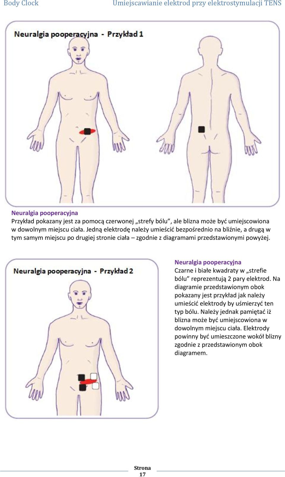 Neuralgia pooperacyjna Czarne i białe kwadraty w strefie bólu reprezentują 2 pary elektrod.