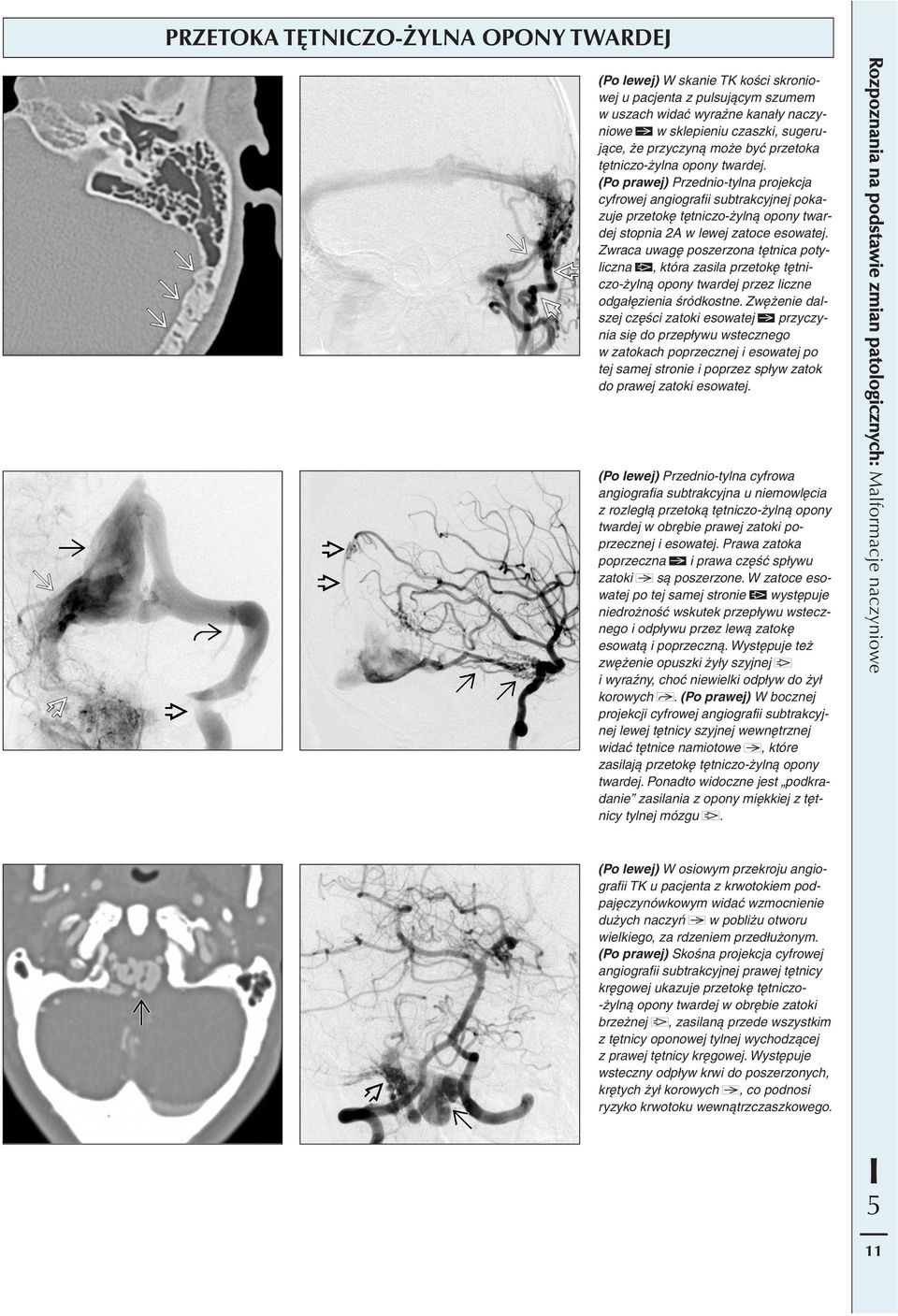 (Po prawej) Przednio-tylna projekcja cyfrowej angiografii subtrakcyjnej pokazuje przetokę tętniczo-żylną opony twardej stopnia 2A w lewej zatoce esowatej.
