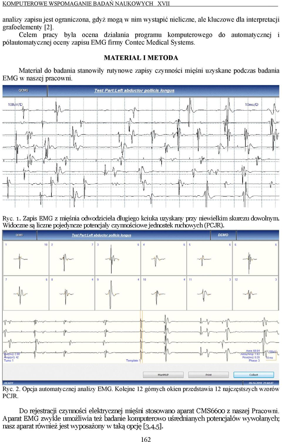 MATERIAŁ I METODA Materiał do badania stanowiły rutynowe zapisy czynności mięśni uzyskane podczas badania EMG w naszej pracowni. Ryc. 1.