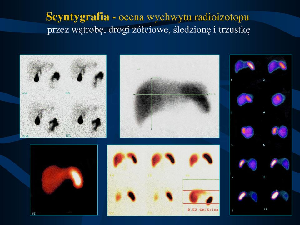 przez wątrobę, drogi