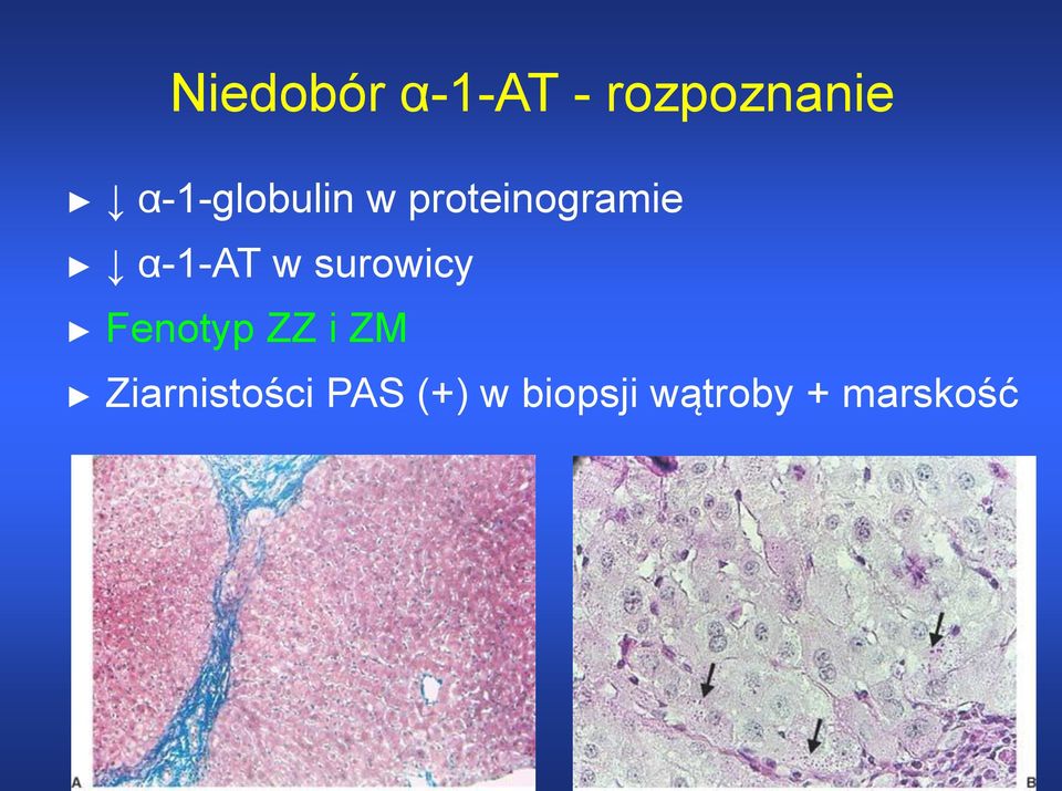 α-1-at w surowicy Fenotyp ZZ i ZM