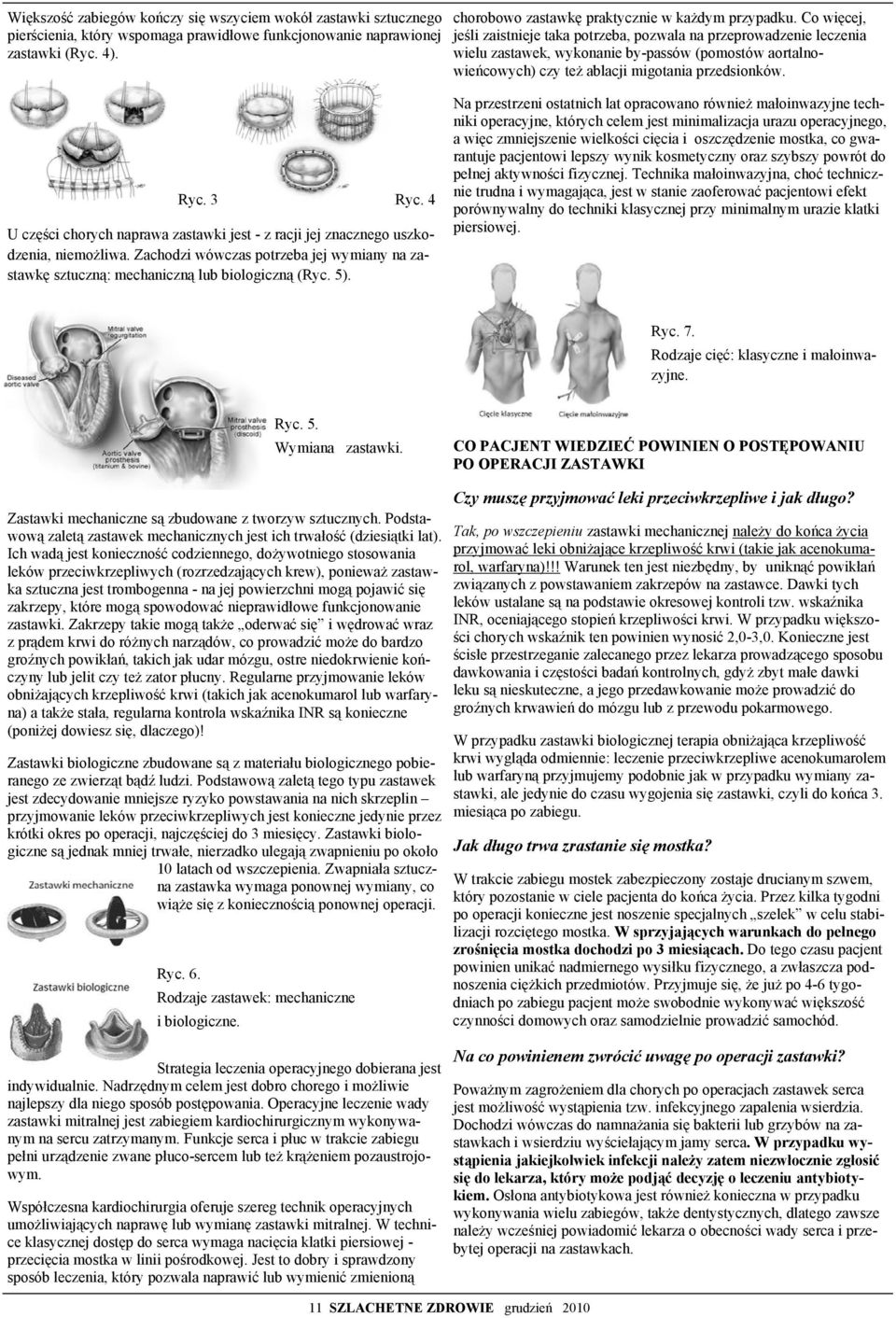 4 U części chorych naprawa zastawki jest - z racji jej znacznego uszkodzenia, niemożliwa. Zachodzi wówczas potrzeba jej wymiany na zastawkę sztuczną: mechaniczną lub biologiczną (Ryc. 5).