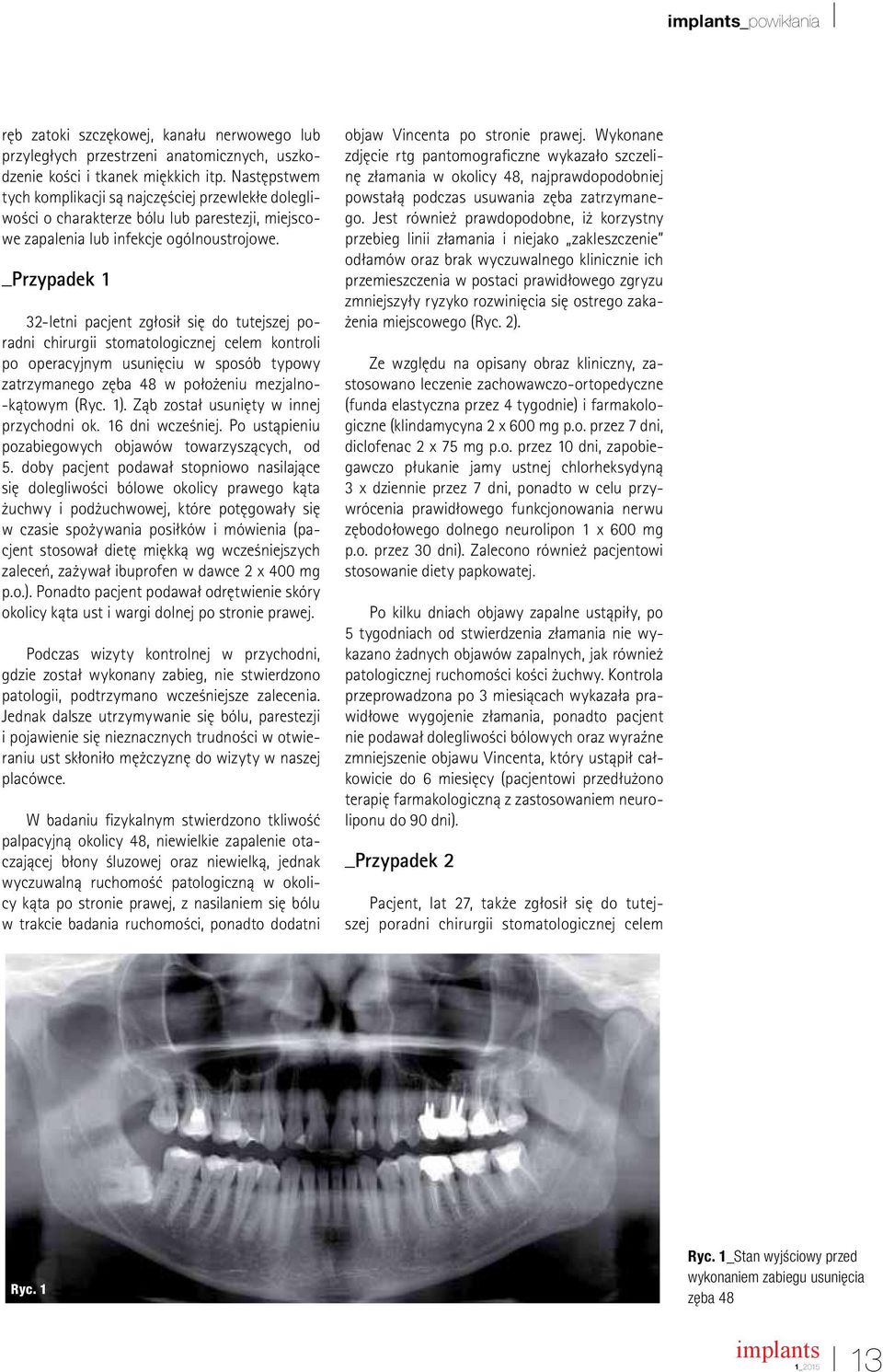 _Przypadek 1 32-letni pacjent zgłosił się do tutejszej poradni chirurgii stomatologicznej celem kontroli po operacyjnym usunięciu w sposób typowy zatrzymanego zęba 48 w położeniu mezjalno- -kątowym