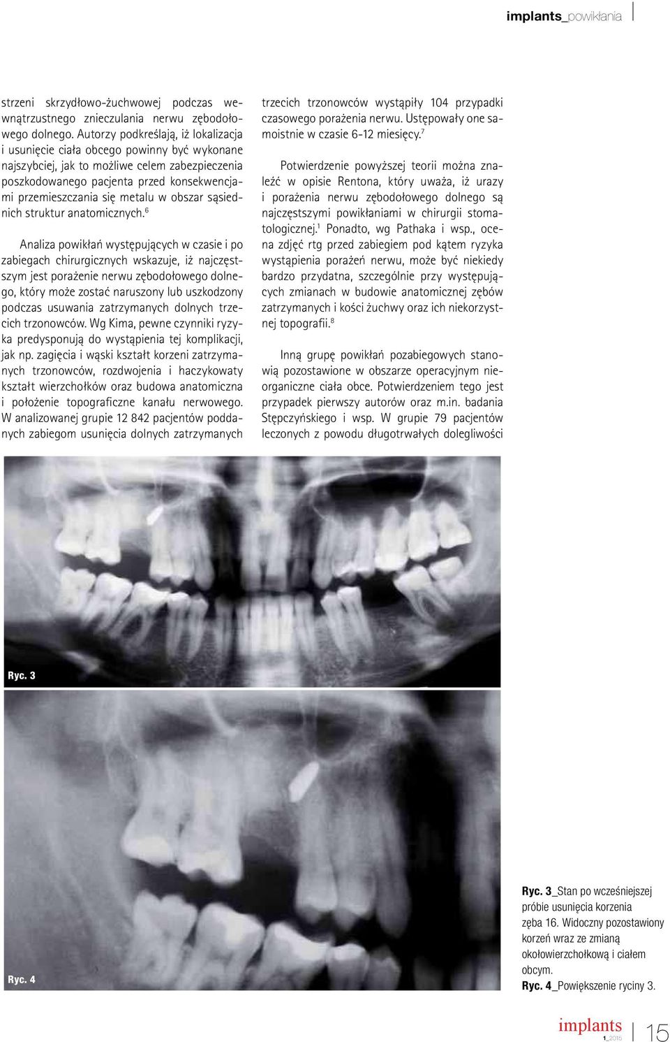 metalu w obszar sąsiednich struktur anatomicznych.