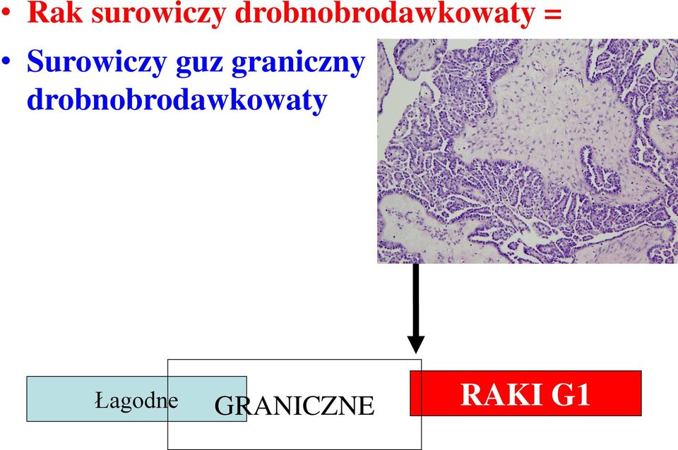 Surowiczy guz graniczny