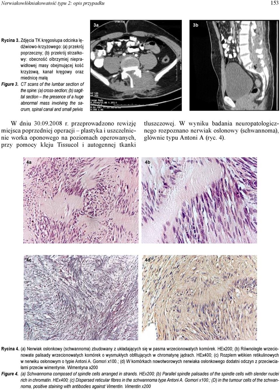 małą Figure 3. CT scans of the lumbar section of the spine: (a) cross-section; (b) sa gittal section the presence of a huge abnormal mass involving the sacrum, spinal canal and small pelvis W dniu 30.