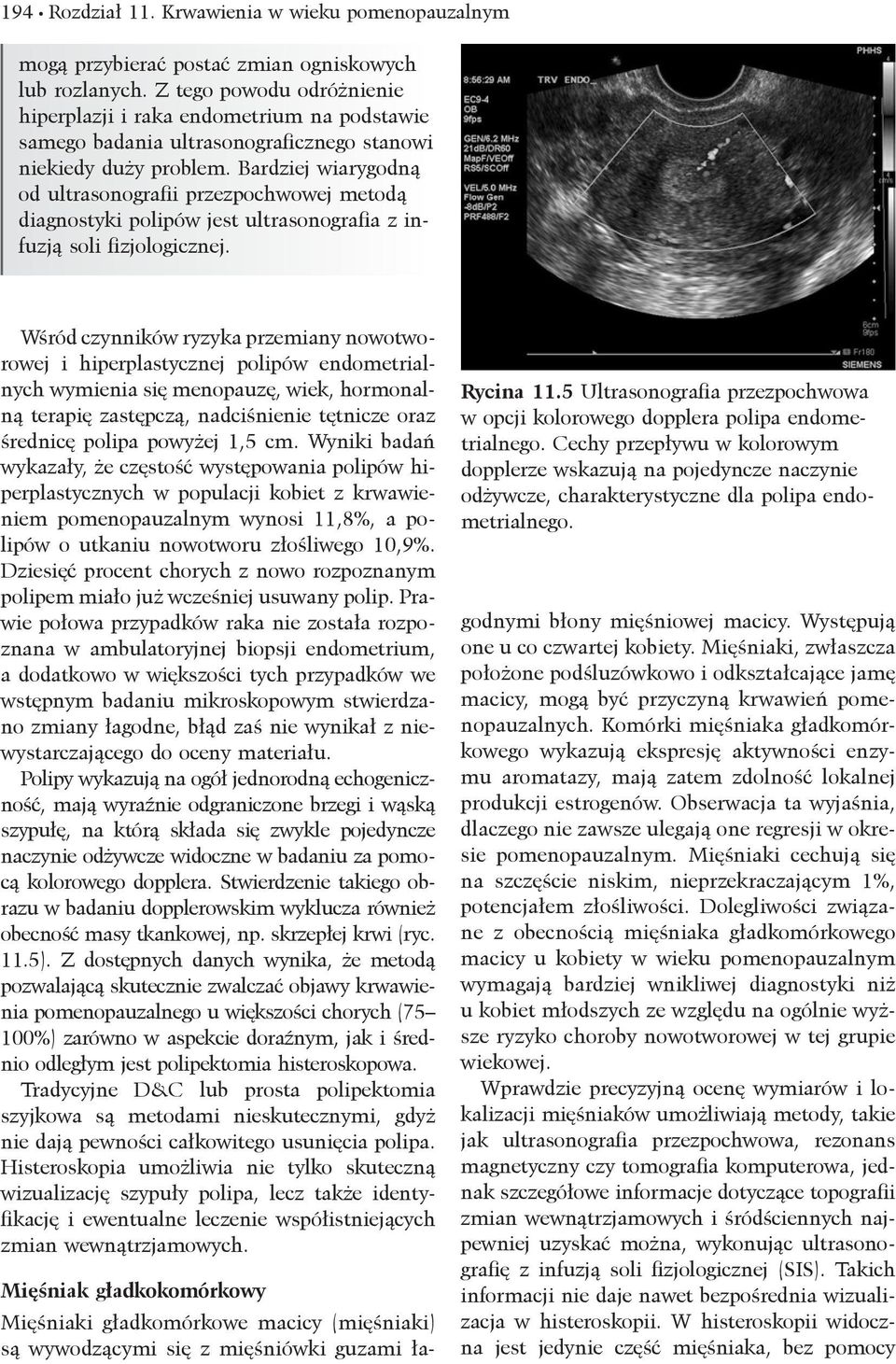 Bardziej wiarygodną od ultrasonografii przezpochwowej metodą diagnostyki polipów jest ultrasonografia z infuzją soli fizjologicznej.