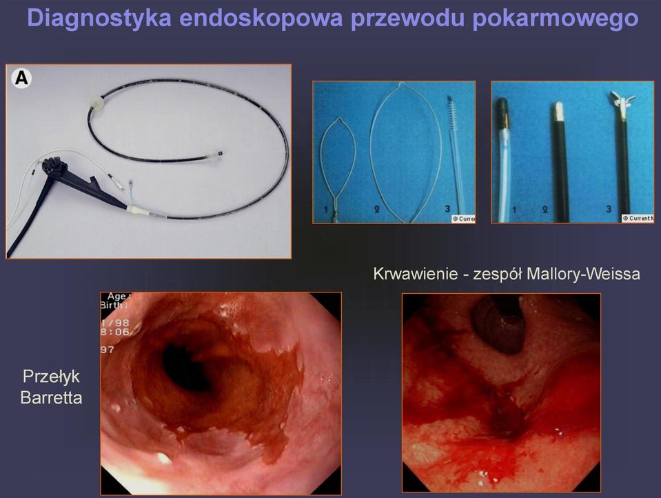 Krwawienie - zespół