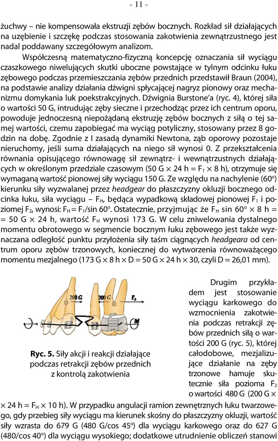 przedstawił Braun (2004), na podstawie analizy działania dźwigni spłycającej nagryz pionowy oraz mechanizmu domykania luk poekstrakcyjnych. Dźwignia Burstone a (ryc.