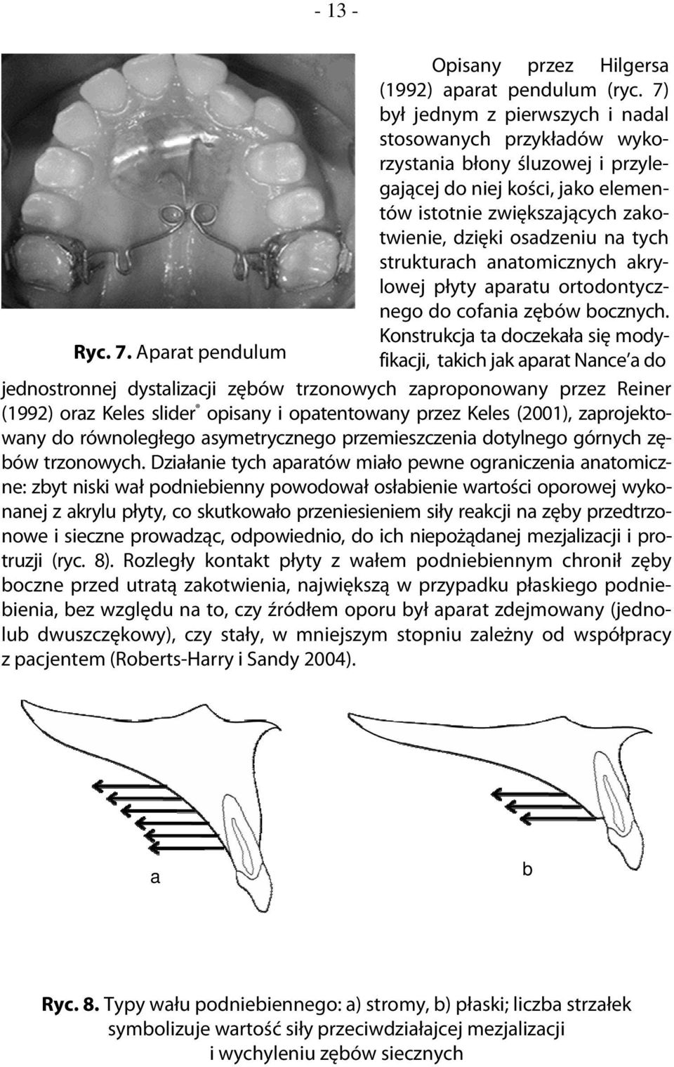 strukturach anatomicznych akrylowej płyty aparatu ortodontycznego do cofania zębów bocznych. Konstrukcja ta doczekała się modyfikacji, takich jak aparat Nance a do Ryc. 7.