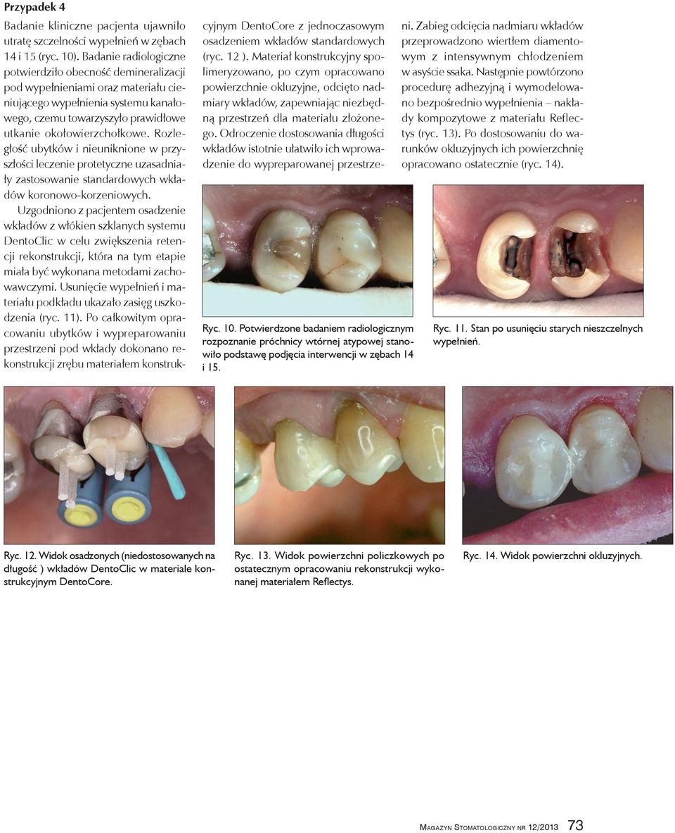 Badanie radiologiczne potwierdziło obecność demineralizacji pod wypełnieniami oraz materiału cieniującego wypełnienia systemu kanałowego, czemu towarzyszyło prawidłowe utkanie okołowierzchołkowe.