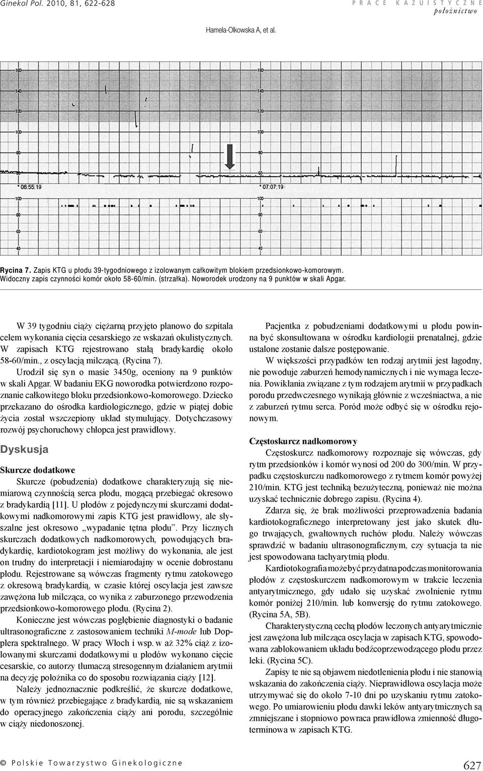 W zapisach KTG rejestrowano stałą bradykardię około 58-60/min., z oscylacją milczącą. (Rycina 7). Urodził się syn o masie 3450g, oceniony na 9 punktów w skali Apgar.