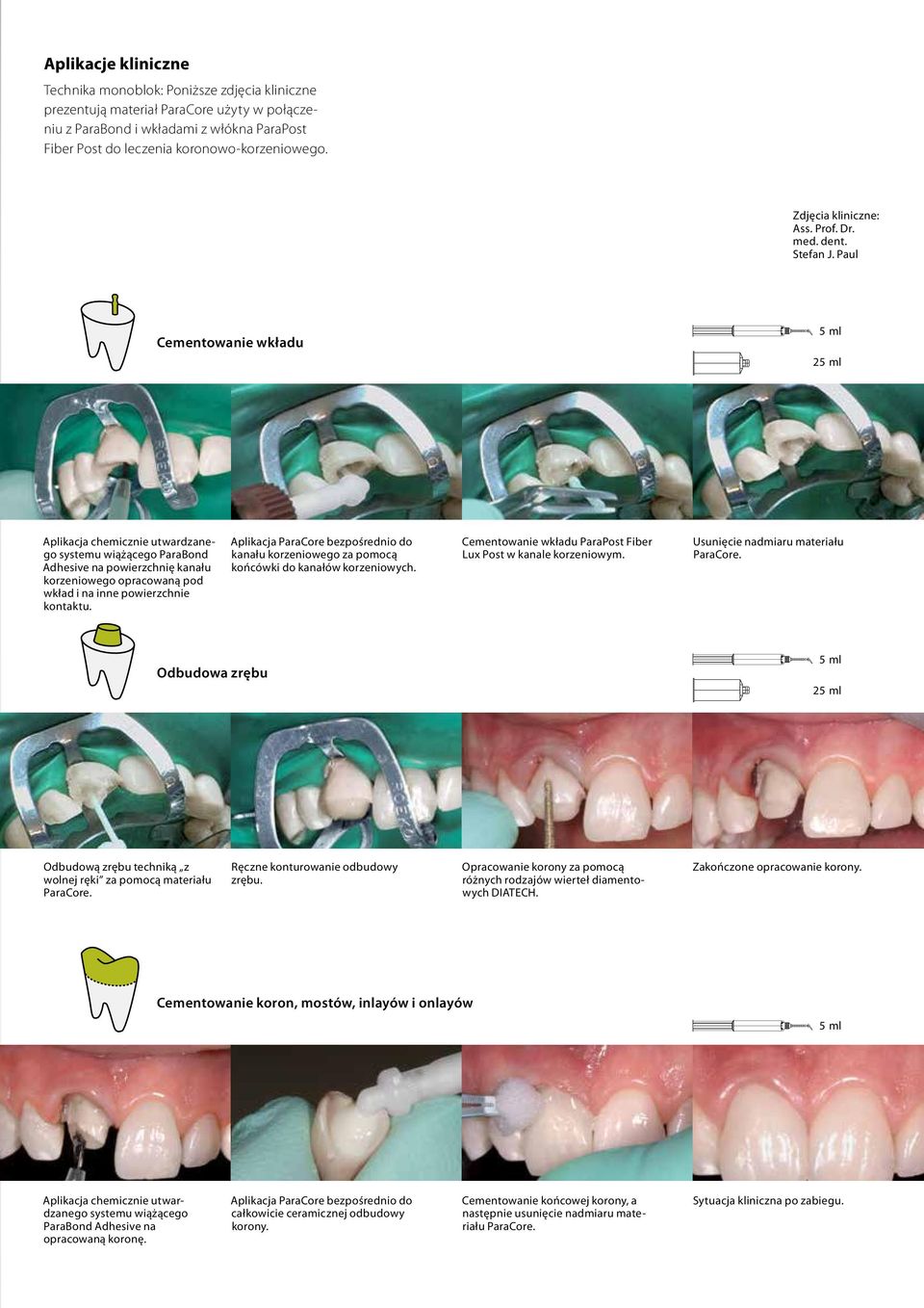 Paul Cementowanie wkładu 2 Aplikacja chemicznie utwardzanego systemu wiążącego ParaBond Adhesive na powierzchnię kanału korzeniowego opracowaną pod wkład i na inne powierzchnie kontaktu.