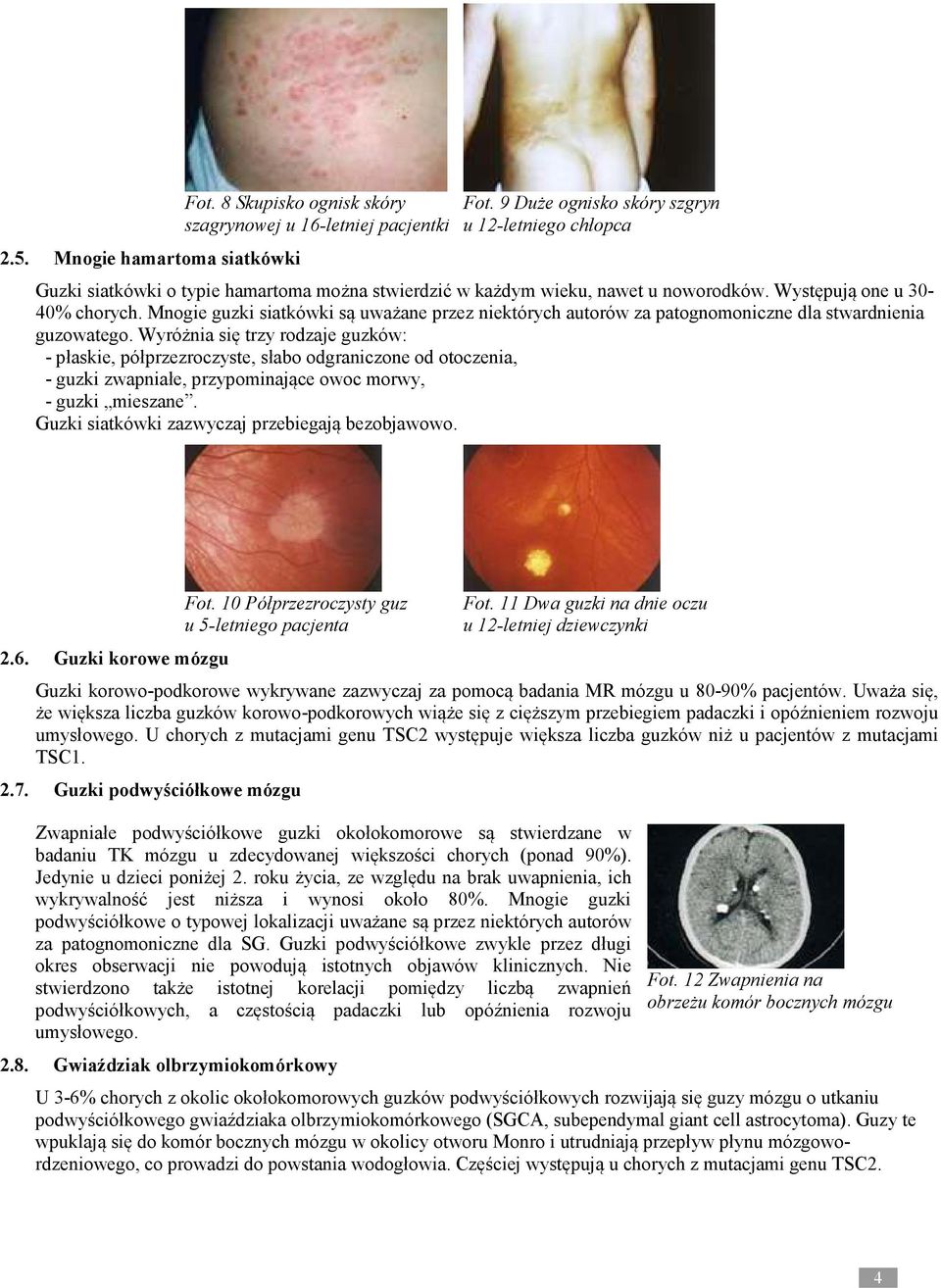 Mnogie guzki siatkówki są uważane przez niektórych autorów za patognomoniczne dla stwardnienia guzowatego.