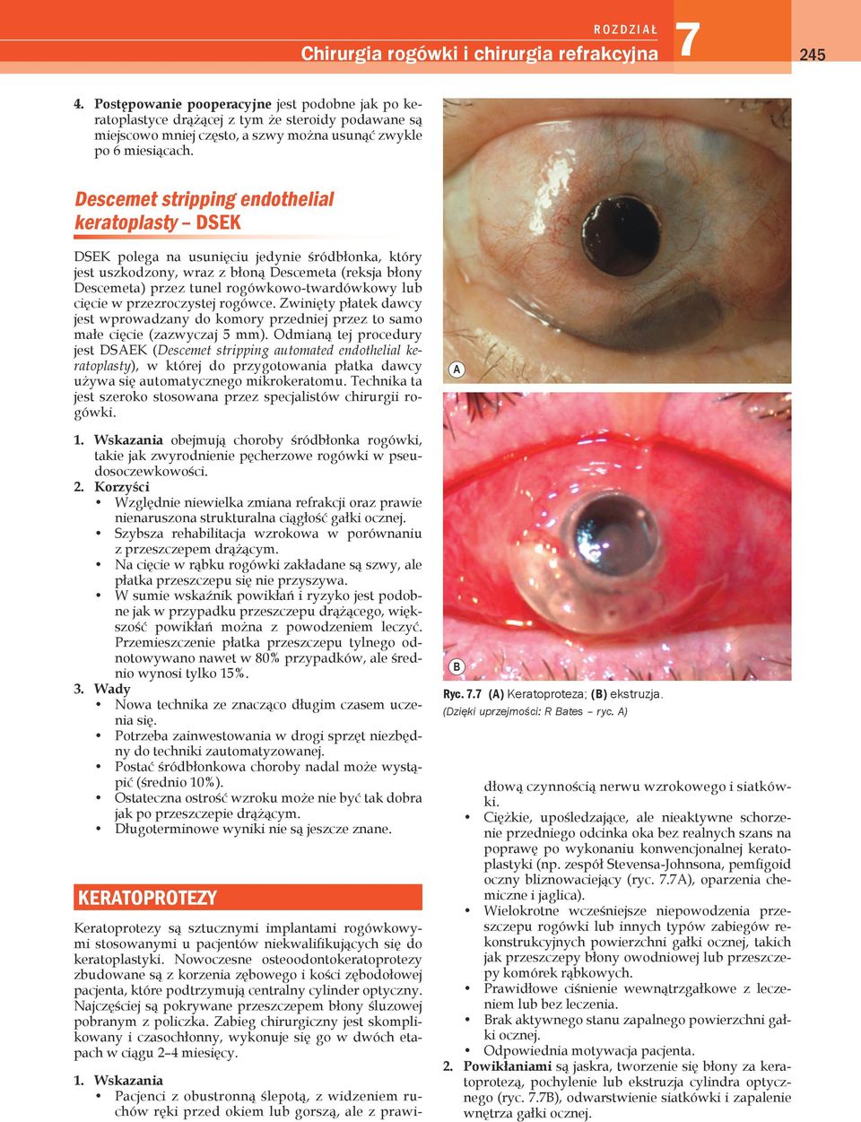 Descemet stripping endothelial keratoplasty DSEK DSEK polega na usunięciu jedynie śródbłonka, który jest uszkodzony, wraz z błoną Descemeta (reksja błony Descemeta) przez tunel rogówkowo-twardówkowy