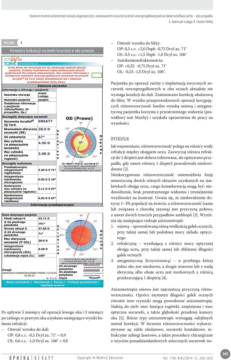 71 OL: -0,25-1,0 Dcyl ax. 106. Pacjentka po operacji zaćmy z implantacją torycznych soczewek wewnątrzgałkowych w obu oczach aktualnie nie wymaga korekcji do dali.