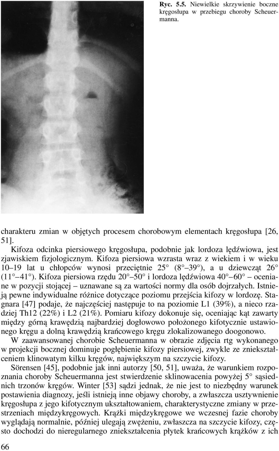 Kifoza piersiowa wzrasta wraz z wiekiem i w wieku 10 19 lat u chłopców wynosi przeciętnie 25 (8 39 ), a u dziewcząt 26 (11 41 ).