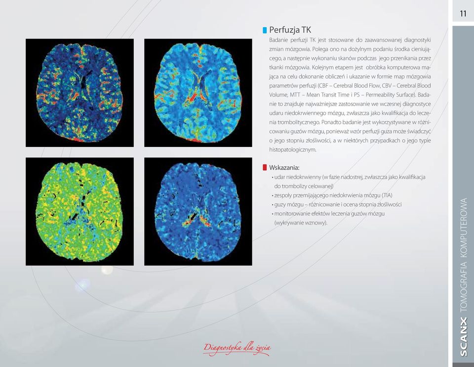 Kolejnym etapem jest obróbka komputerowa mająca na celu dokonanie obliczeń i ukazanie w formie map mózgowia parametrów perfuzji (CBF Cerebral Blood Flow, CBV Cerebral Blood Volume, MTT Mean Transit