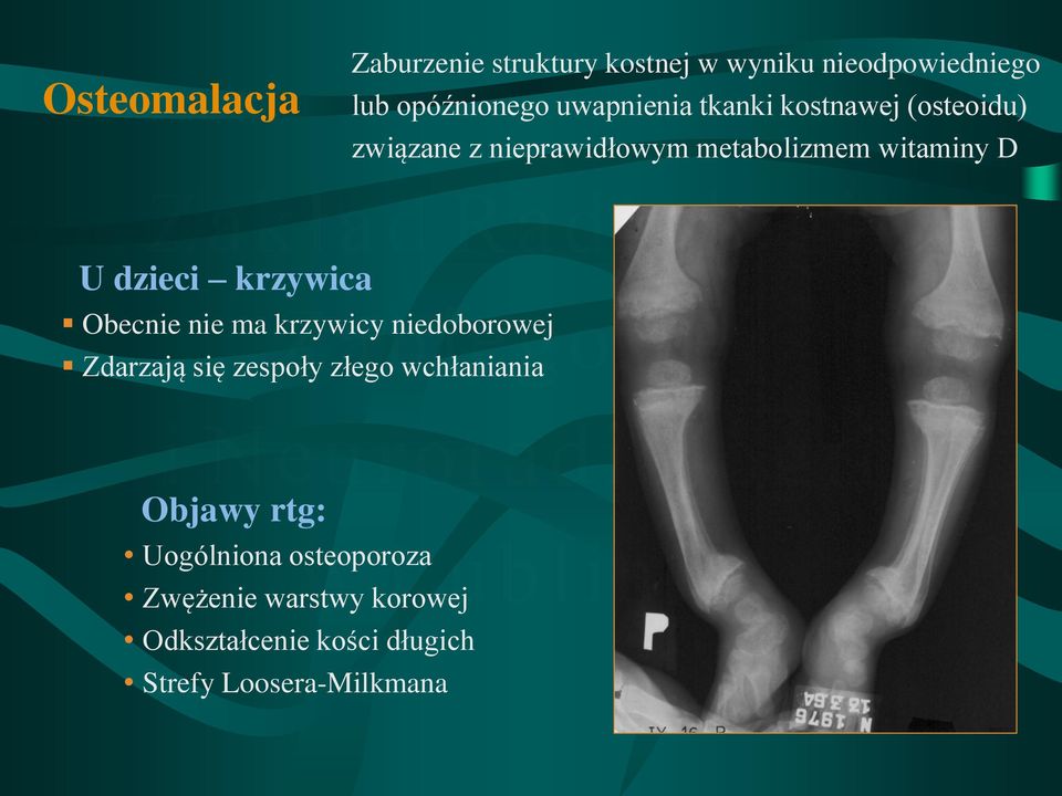 krzywica Obecnie nie ma krzywicy niedoborowej Zdarzają się zespoły złego wchłaniania Objawy