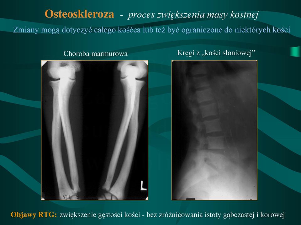 kości Choroba marmurowa Kręgi z kości słoniowej Objawy RTG: