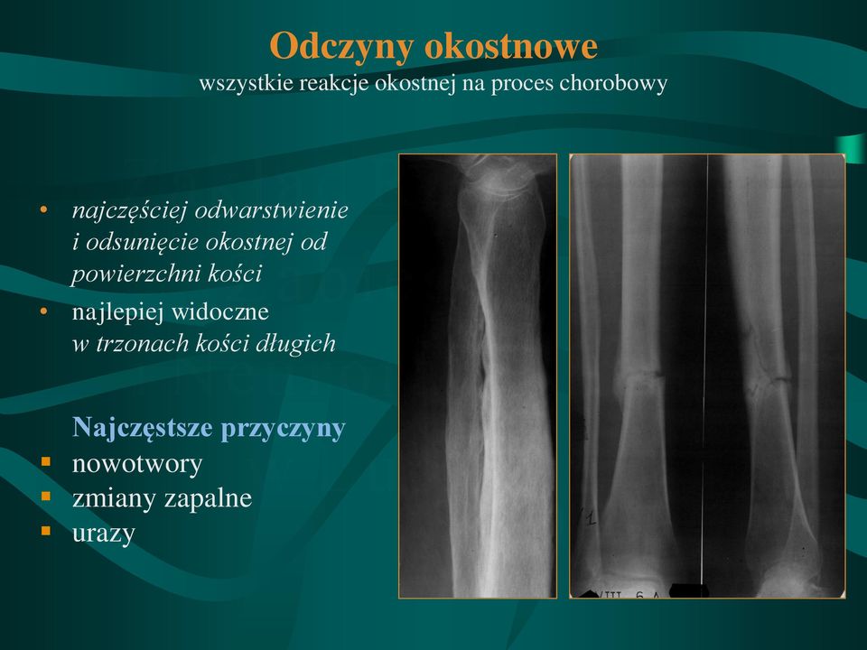 od powierzchni kości najlepiej widoczne w trzonach kości