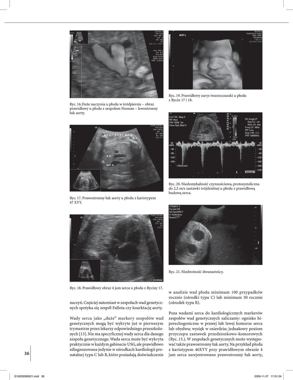Niedrożność dwunastnicy. Ryc. 18. Prawidłowy obraz 4 jam serca u płodu z Ryciny 17. naczyń. Częściej natomiast w zespołach wad genetycznych spotyka się zespół Fallota czy koarktację aorty.