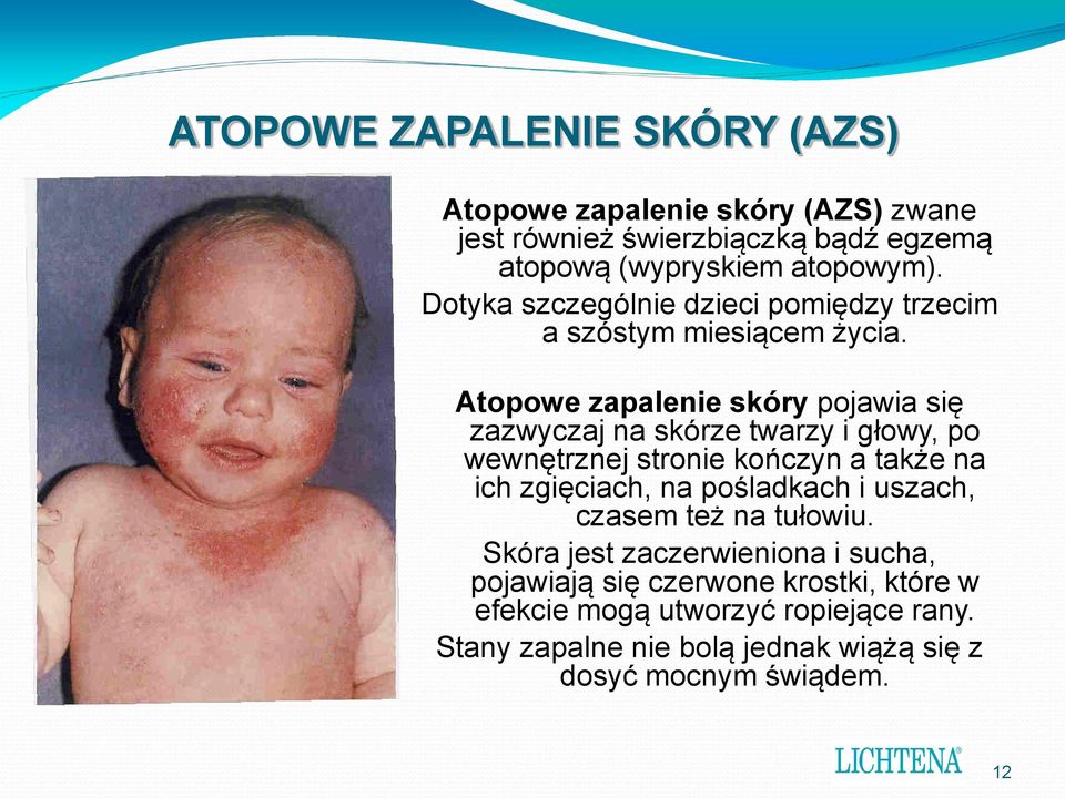 Atopowe zapalenie skóry pojawia się zazwyczaj na skórze twarzy i głowy, po wewnętrznej stronie kończyn a także na ich zgięciach, na