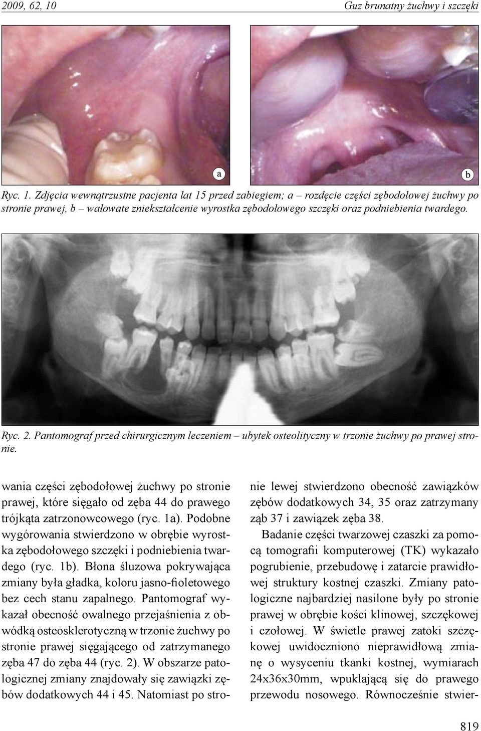 Zdjęcia wewnątrzustne pacjenta lat 15 przed zabiegiem; a rozdęcie części zębodołowej żuchwy po stronie prawej, b wałowate zniekształcenie wyrostka zębodołowego szczęki oraz podniebienia twardego. Ryc.