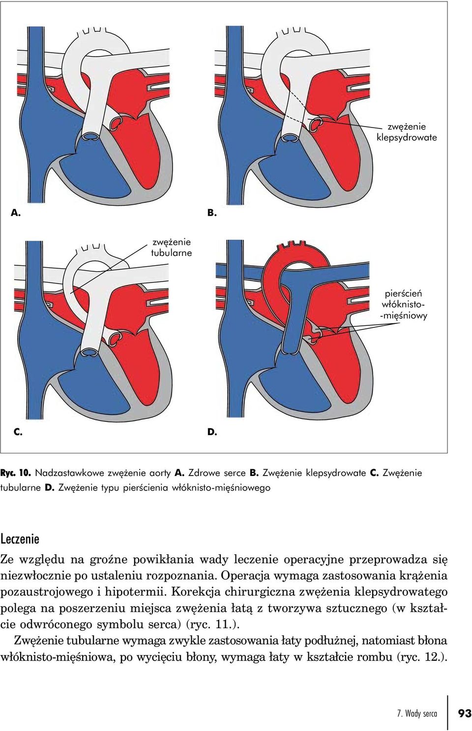 Operacja wymaga zastosowania krążenia pozaustrojowego i hipotermii.