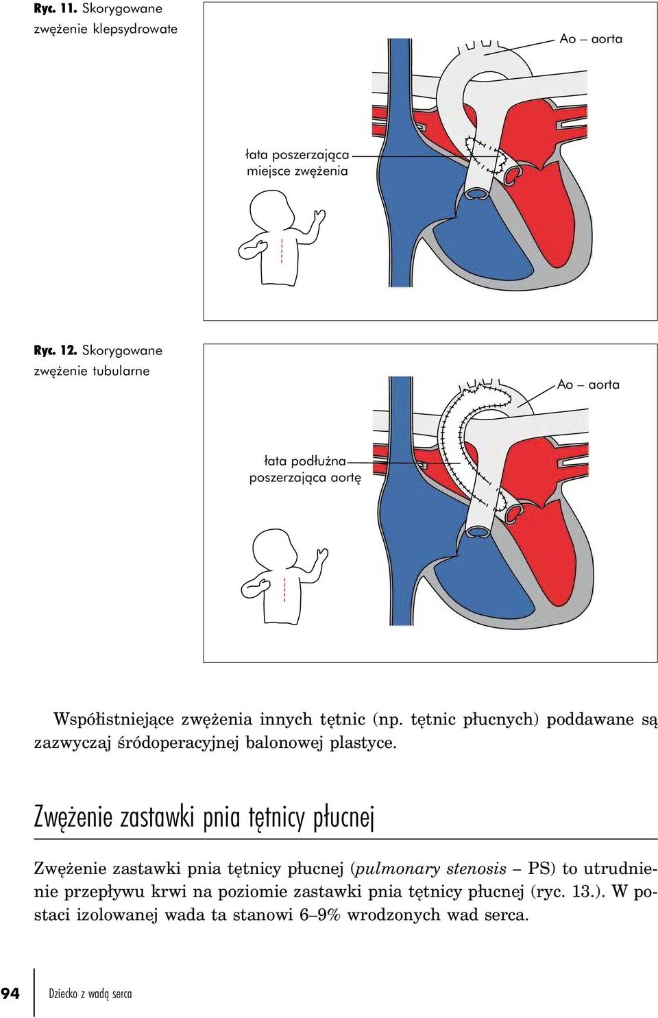 tętnic płucnych) poddawane są zazwyczaj śródoperacyjnej balonowej plastyce.